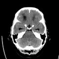 Obstructive hydrocephalus (Radiopaedia 30453-31119 Axial non-contrast 7).jpg