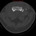 Occipital condyle fracture (Radiopaedia 18366-18208 Axial bone window 23).jpg