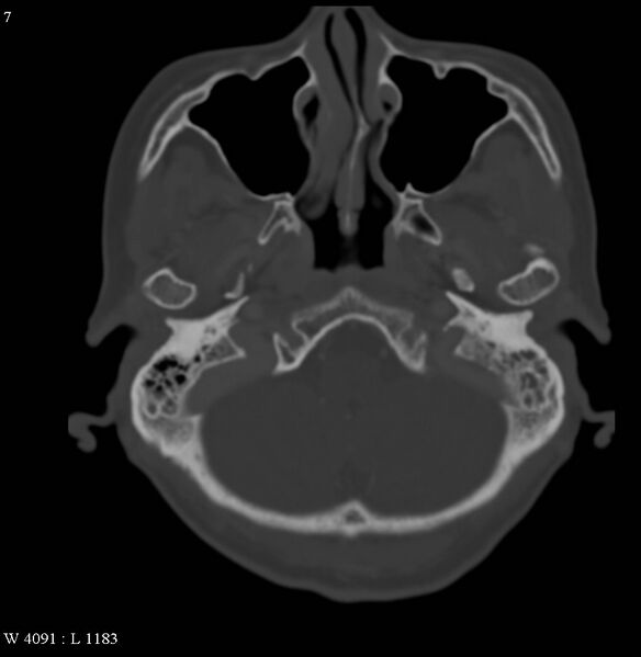File:Occipital condyle metastasis - into mastoid (Radiopaedia 5424-7177 Axial bone window 7).jpg