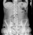 11 pairs of ribs and lumbosacral transitional vertebra (Radiopaedia 61880-69918 D 1).jpg