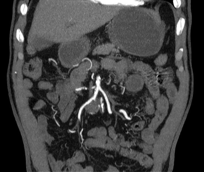 File:Abdominal aortic aneurysm (Radiopaedia 22421-22458 C 7).jpg