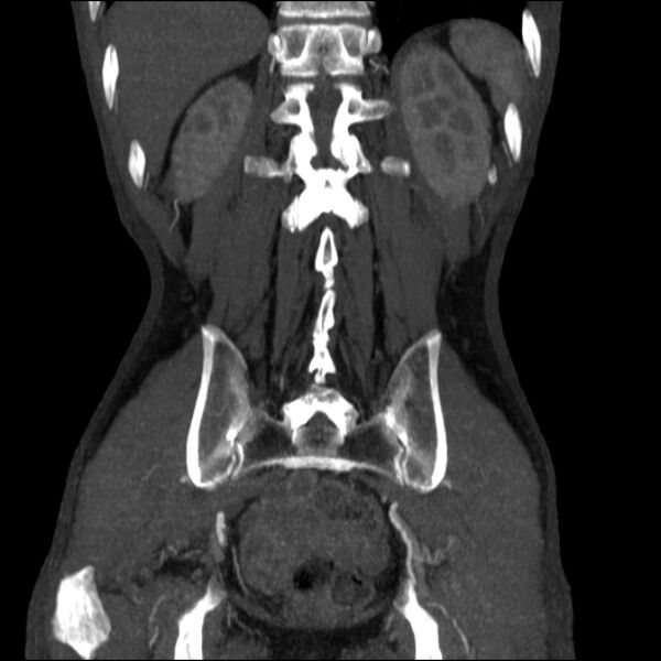 File:Abdominal aortic aneurysm (Radiopaedia 23703-23856 Coronal C+ arterial phase 29).jpg