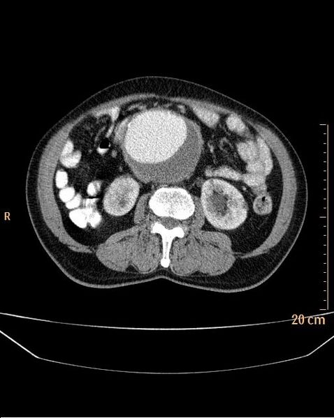 File:Abdominal aortic aneurysm (Radiopaedia 25985-26121 Axial C+ arterial phase 15).jpg