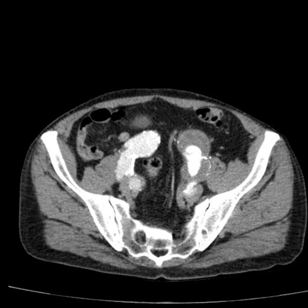 File:Abdominal aortic aneurysm (Radiopaedia 29248-29660 Axial C+ arterial phase 69).jpg