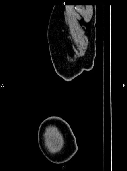 File:Abdominal aortic aneurysm (Radiopaedia 83094-97462 Sagittal renal cortical phase 1).jpg