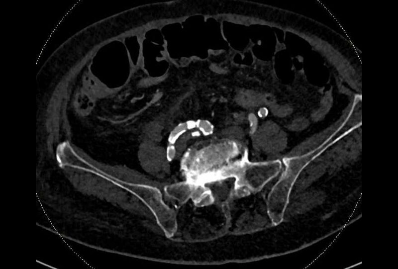 File:Abdominal aortic aneurysm with thrombus fissuration (Radiopaedia 73192-83919 Axial C+ arterial phase 154).jpg
