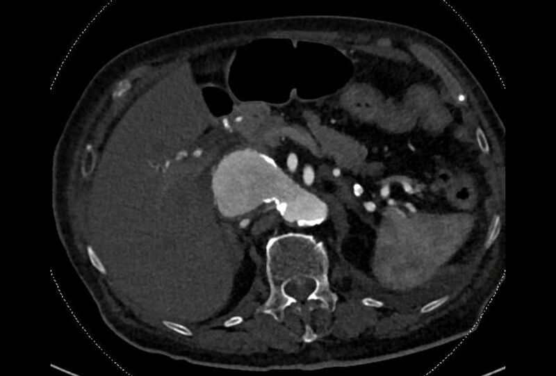 File:Abdominal aortic aneurysm with thrombus fissuration (Radiopaedia 73192-83919 Axial C+ arterial phase 36).jpg
