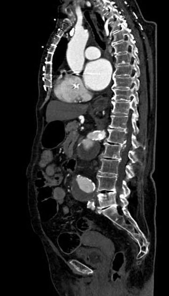 File:Abdominal aortic aneurysm with thrombus fissuration (Radiopaedia 73192-83919 Sagittal C+ arterial phase 70).jpg