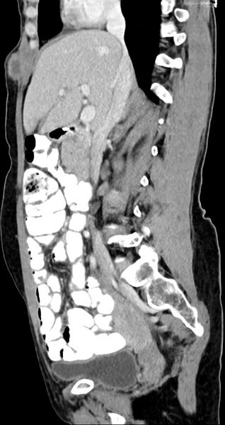 File:Abdominal wall and retroperitoneal tuberculosis (Radiopaedia 88137-104729 Sagittal C+ portal venous phase 90).jpg