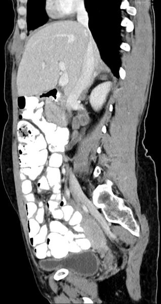 File:Abdominal wall and retroperitoneal tuberculosis (Radiopaedia 88137-104729 Sagittal C+ portal venous phase 92).jpg