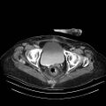 Abdominal wall recurrence after colorectal resection for cancer (Radiopaedia 23444-23523 Axial C+ portal venous phase 37).jpg