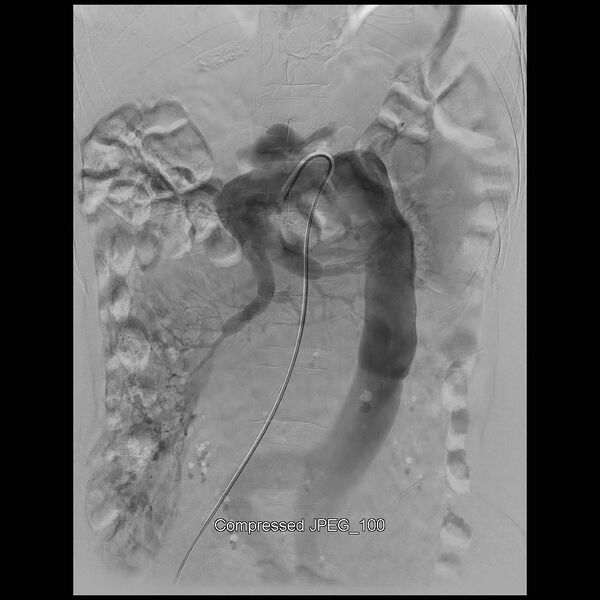 File:Abernethy malformation (Radiopaedia 42006-45462 Frontal Superior mesenteric artery 14).jpg