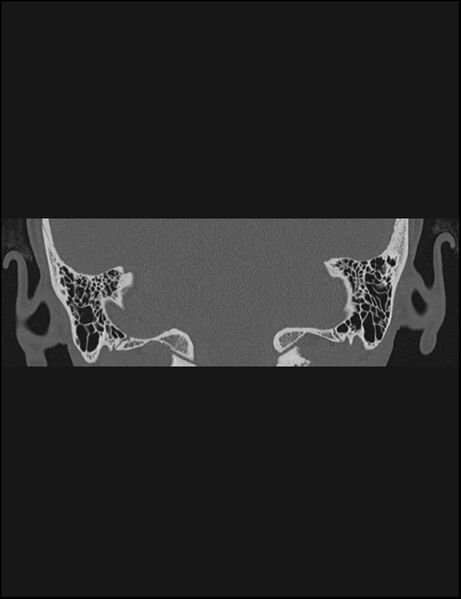 File:Aberrant right internal carotid artery (Radiopaedia 65191-74198 Coronal non-contrast 65).jpg