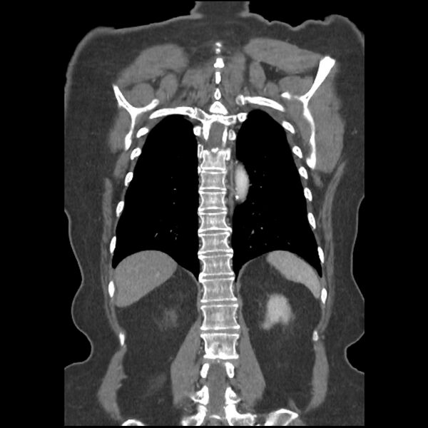 File:Aberrant right subclavian and left vertebral arteries (Radiopaedia 43467-46847 Coronal C+ portal venous phase 68).jpg