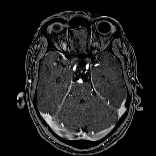 File:Accessory middle cerebral artery (Radiopaedia 73114-83828 Axial MRA 61).jpg