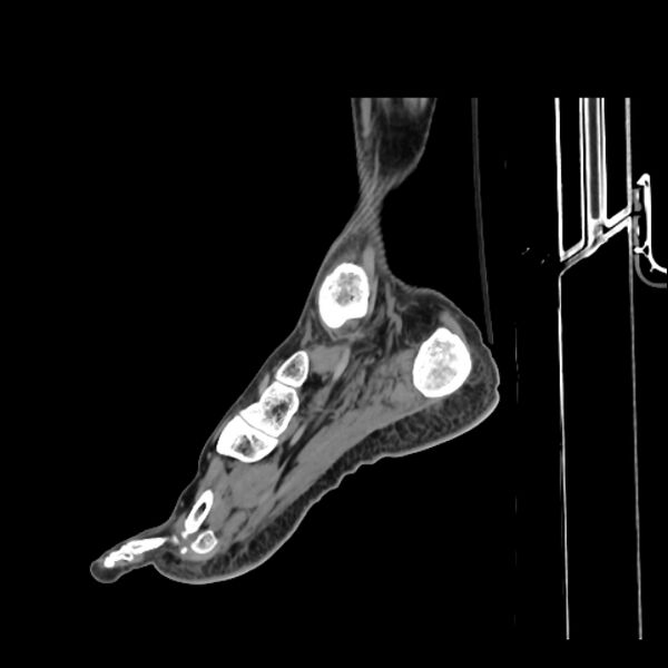 File:Accessory soleus muscle (Radiopaedia 61069-68943 Sagittal non-contrast 32).jpg