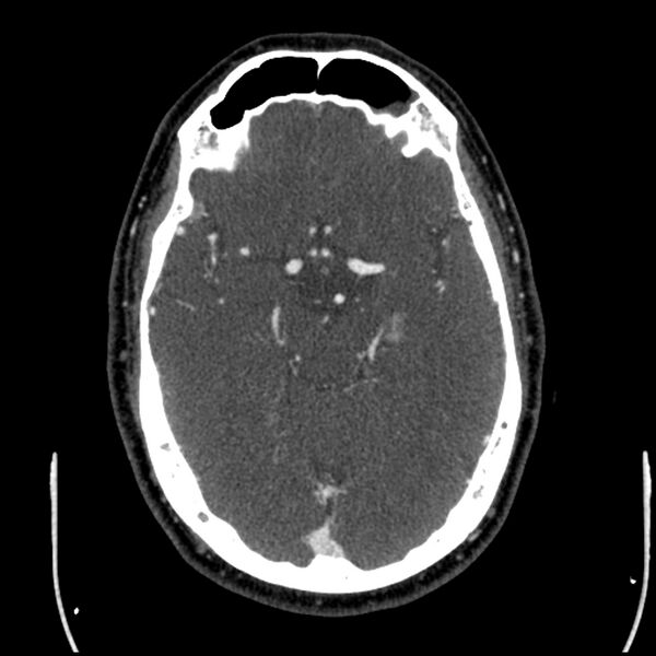 File:Acute A3 occlusion with ACA ischemic penumbra (CT perfusion) (Radiopaedia 72036-82527 Axial C+ arterial phase thins 101).jpg