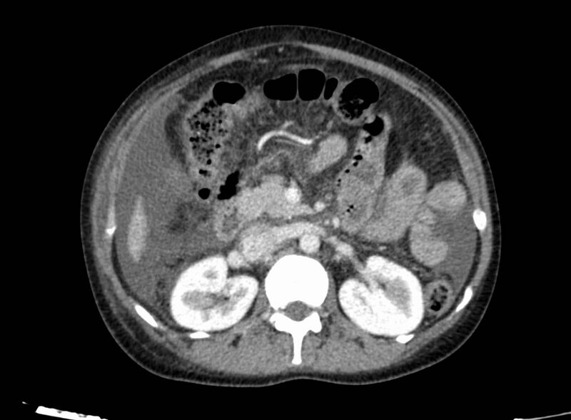 File:Acute Budd-Chiari syndrome (Radiopaedia 60858-68638 Axial C+ portal venous phase 122).jpg