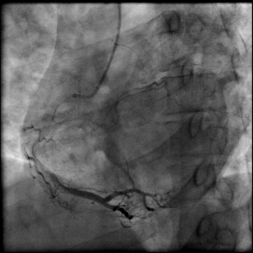 Acute anteroseptal myocardial infarction (Radiopaedia 68409-77946 RAO straight RCA 50).jpg