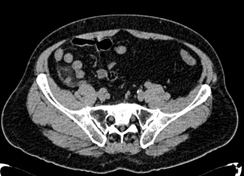 File:Acute appendicitis (Radiopaedia 13030-13091 Axial non-contrast 38).jpg