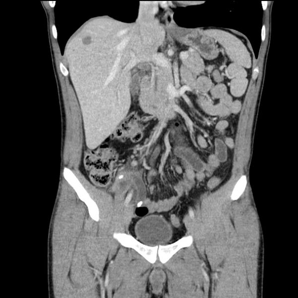 File:Acute appendicitis (Radiopaedia 27049-27227 Coronal C+ portal venous phase 23).jpg