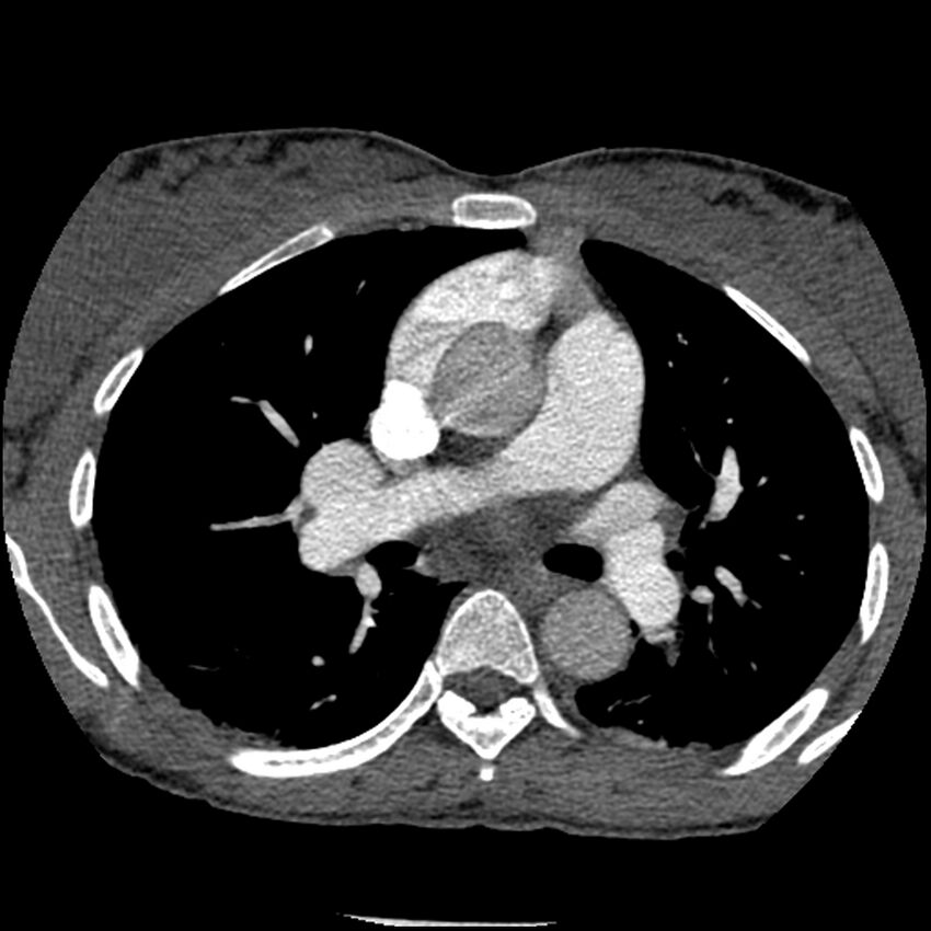 Acute chest syndrome - sickle cell disease (Radiopaedia 42375-45499 Axial C+ CTPA 84).jpg