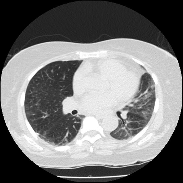 File:Acute interstitial pneumonitis (Radiopaedia 45404-49444 Axial lung window 57).jpg