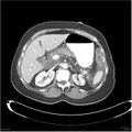 Acute pancreatitis (Radiopaedia 19136-19117 Axial C+ portal venous phase 10).jpg