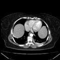 Acute pancreatitis - Balthazar C (Radiopaedia 26569-26714 Axial C+ arterial phase 6).jpg