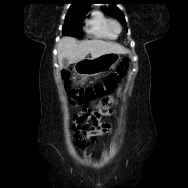 File:Acute pancreatitis - Balthazar C (Radiopaedia 26569-26714 Coronal C+ portal venous phase 19).jpg