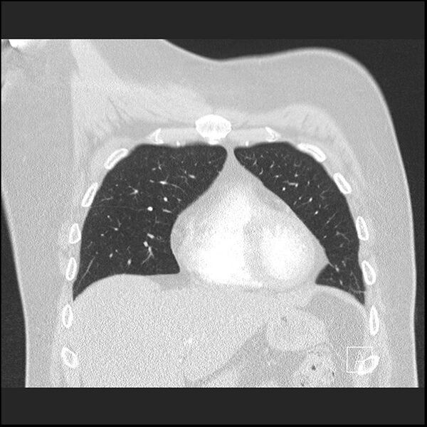 File:Acute pulmonary embolism with pulmonary infarct (Radiopaedia 73062-83768 Coronal lung window 19).jpg
