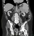 Acute renal failure post IV contrast injection- CT findings (Radiopaedia 47815-52559 Coronal C+ portal venous phase 20).jpg