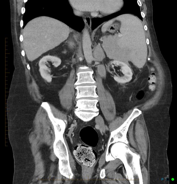 File:Acute renal failure post IV contrast injection- CT findings (Radiopaedia 47815-52559 Coronal C+ portal venous phase 20).jpg