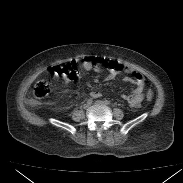 File:Acute tubular necrosis (Radiopaedia 28077-28334 Axial non-contrast 43).jpg