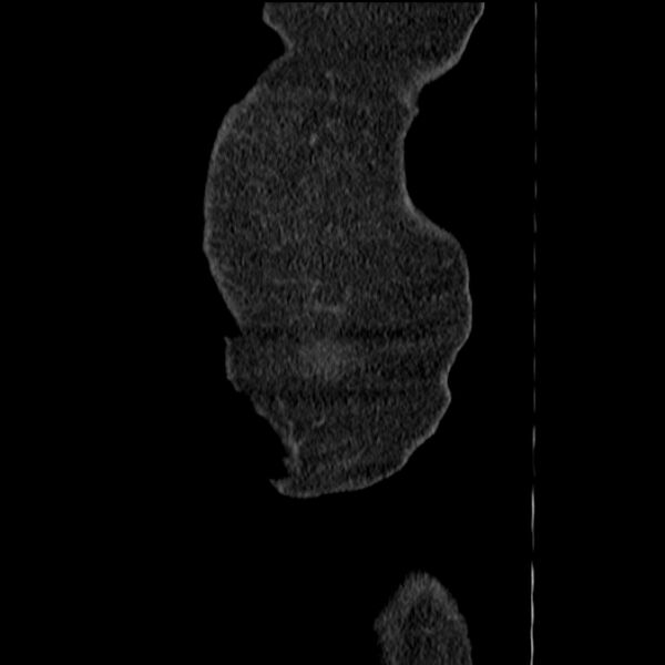 File:Acute tubular necrosis (Radiopaedia 28077-28334 H 1).jpg