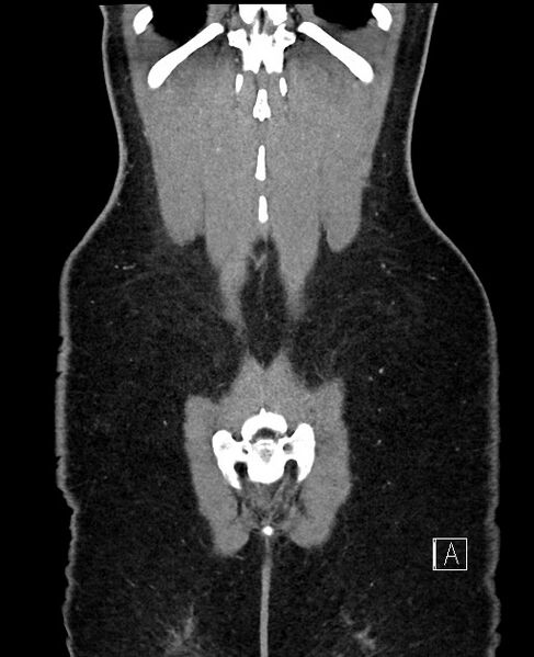 File:Acute uncomplicated appendicitis (Radiopaedia 61374-69304 Coronal C+ portal venous phase 97).jpg