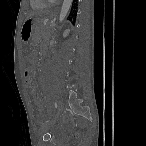 File:Acute vertebral body compression fractures (Radiopaedia 31757-32693 Sagittal bone window 10).jpg