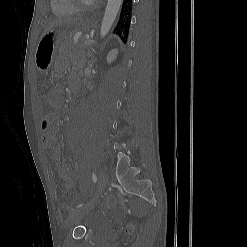 Acute vertebral body compression fractures (Radiopaedia 31757-32693 Sagittal bone window 10).jpg