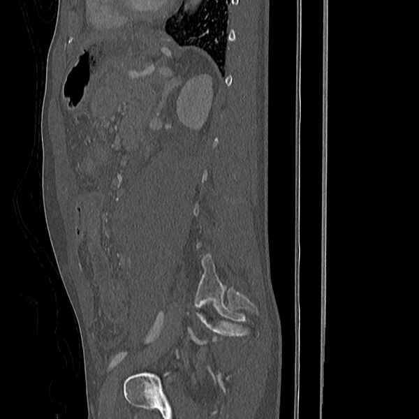 File:Acute vertebral body compression fractures (Radiopaedia 31757-32693 Sagittal bone window 6).jpg