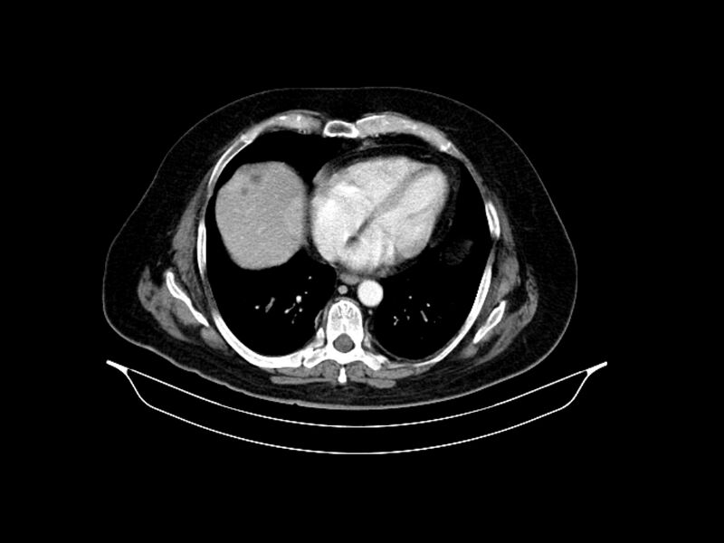 File:Adenocarcinoma of pancreas with hepatic metastasis (Radiopaedia 64332-73122 Axial C+ portal venous phase 12).jpg