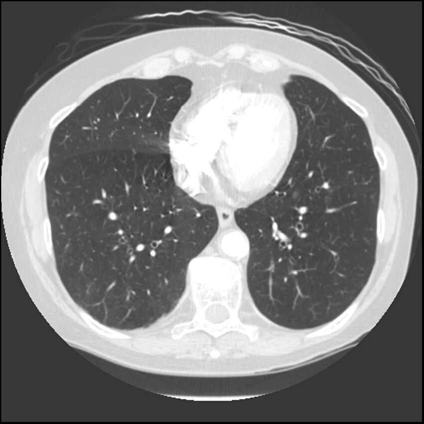 Adenocarcinoma of the lung (Radiopaedia 41015-43755 Axial lung window 85).jpg
