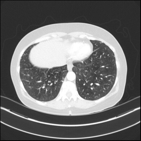 File:Adenocarcinoma of the lung (Radiopaedia 44205-47803 Axial lung window 71).jpg