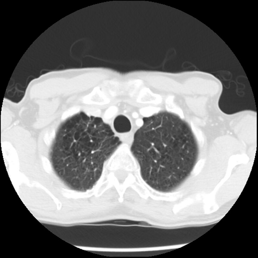 Adenocarcinoma of the lung - micropapillary predominant (Radiopaedia 42446-45563 Axial lung window 11).jpg