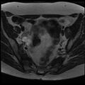 Adenoma malignum of the cervix (Radiopaedia 24460-24765 C 3).jpg