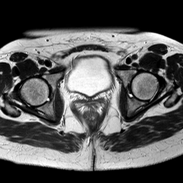 File:Adenomyoma of the uterus (Radiopaedia 9871-10439 Axial T2 9).jpg