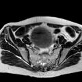 Adenomyoma of the uterus (huge) (Radiopaedia 9870-10438 Axial T2 30).jpg