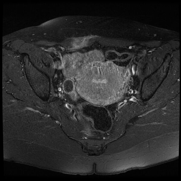 File:Adenomyosis-scar endometriosis (Radiopaedia 65863-75022 Axial T1 C+ fat sat 12).jpg