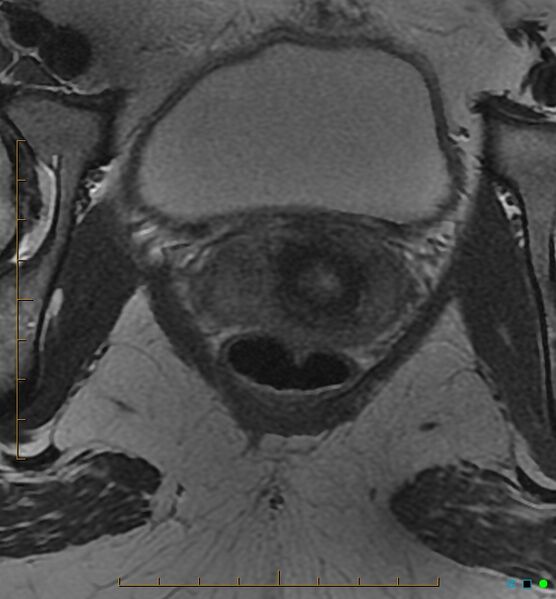 File:Adenomyosis uterus with hematometra (Radiopaedia 45779-50011 Axial T2 26).jpg
