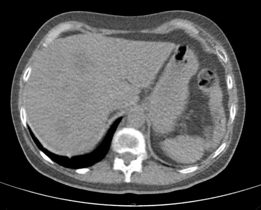 Adenosquamous lung carcinoma (Radiopaedia 22035-22030 non-contrast 55).jpg