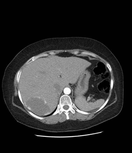 File:Adrenal cortical carcinoma with IVC invasion and thrombosis (Radiopaedia 34307-35597 Axial C+ arterial phase 17).jpg